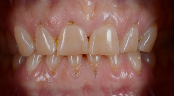 before porcelain veneers