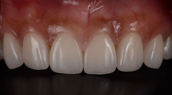 case 2 porcelain veneers after