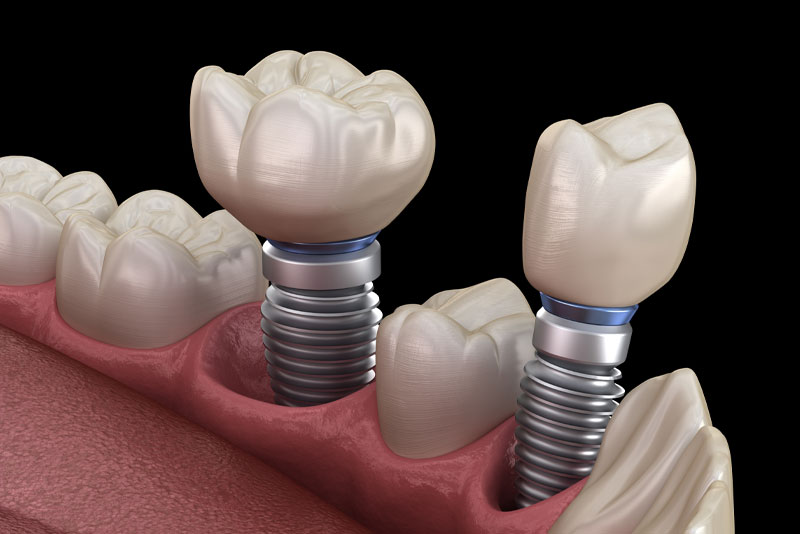 dental implants model 2 2